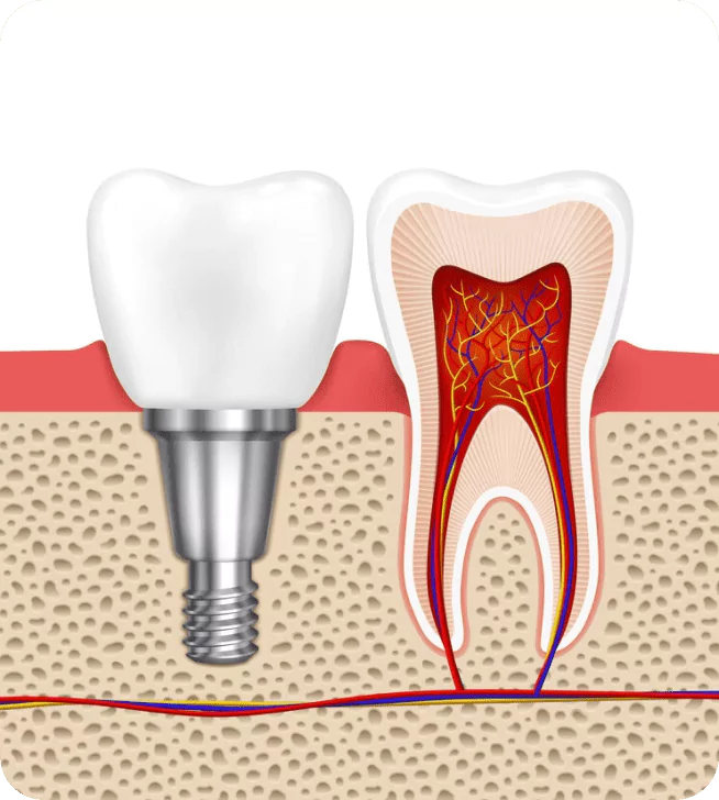 Advanced Hands-on Implant Course