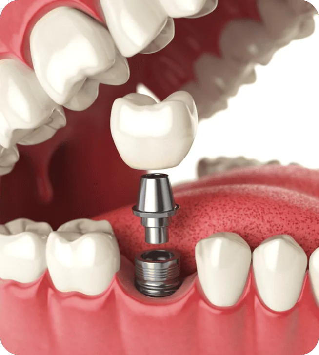 Hands-on Sinus Lift Course