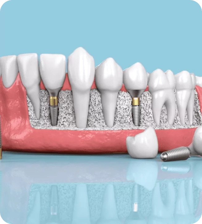 Hands-on Bone Grafting Course